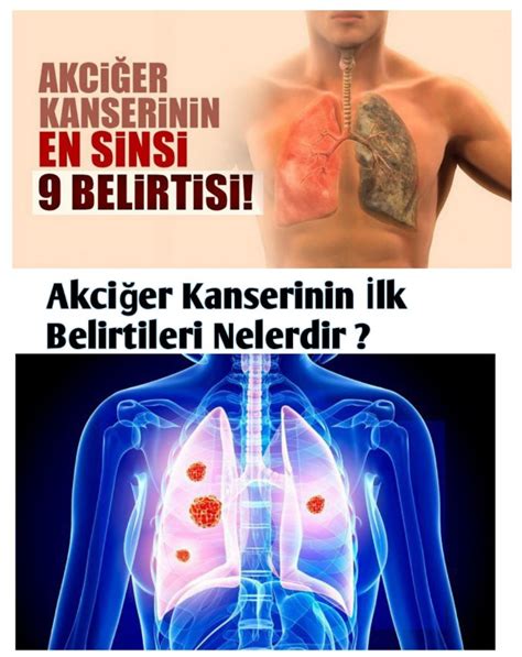 "Akciğer Kanseri Belirtileri Nelerdir?"